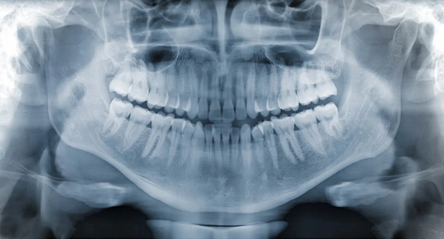 Dental X-Rays