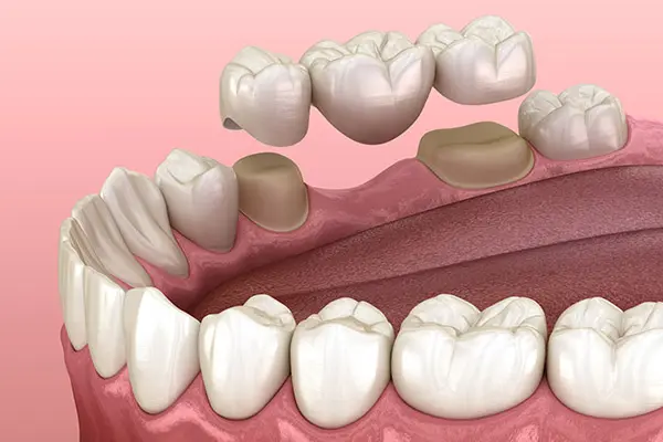 Tooth Replacement Options at Spire Dental Care