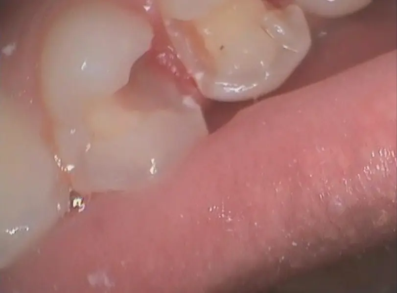 Dentist drills cavity out from patient tooth