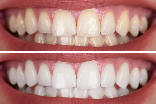 Teeth Whitening at Spire Dental Care in Langley, BC