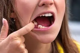 Tooth Extractions at Spire Dental Care in Langley, BC